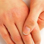 Mani screpolate: quali sono i migliori rimedi