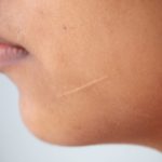 Cicatrici: ecco come eliminarle