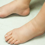 Piedi gonfi a causa del caldo: quali scarpe usare