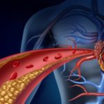 Ipercolesterolemia familiare: cos’è e come si cura