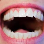 Mascherine per denti storti: ma funzionano davvero?