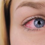 Il freddo irrita gli occhi: ecco come intervenire