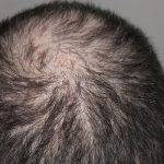 Perdita di capelli: segni, cause e prevenzioni