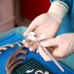 Orecchio ricostruito grazie alla stampa 3D: è successo al Meyer