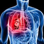 Cancro al polmone: Ispro in prima fila nella prevenzione