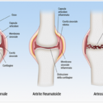 Artrite reumatoide e osteoartrosi: prevenzione e cura