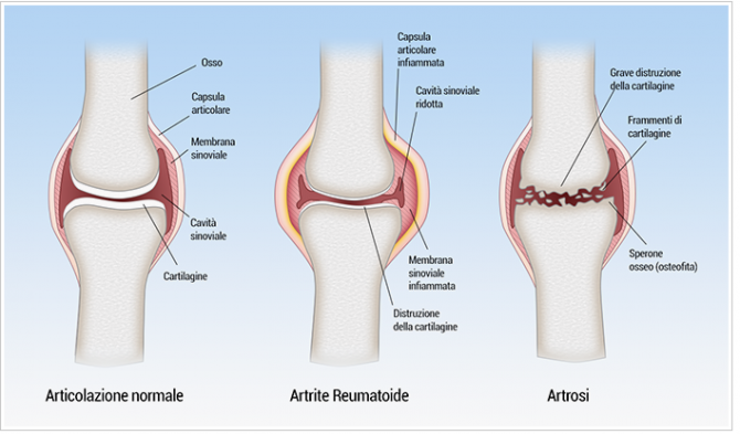 artrite reumatoide e osteoartrite
