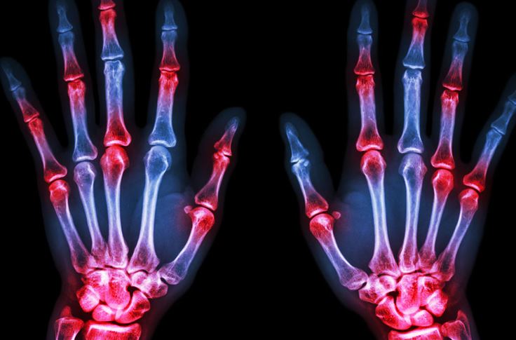 artrite reumatoide e osteoartrite