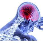 Diagnosi e trattamento del cancro al cervello: progressi grazie all’intelligenza artificiale