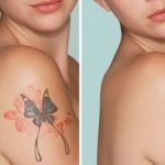 Istruzioni per la rimozione dei tatuaggi