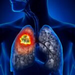 Farmaco a bersaglio molecolare efficace contro il tumore al polmone