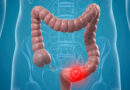 tumori al colon