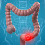 La prevenzione dei tumori al colon deve iniziare a 45 anni