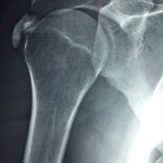 Quale fisioterapia per la frattura dell’omero