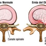 La chiropratica come cura dell’ernia del disco
