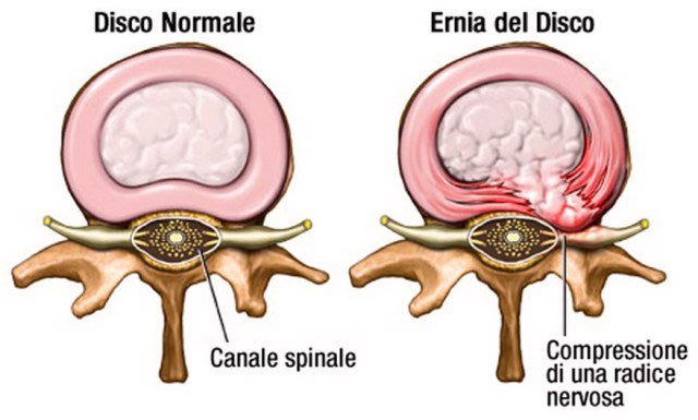 ernia del disco - ph da centrochiropraticomonzese